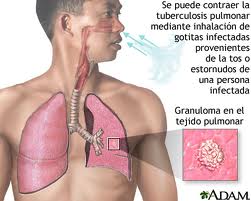 Cuba y México acuerdan plan de combate a tuberculosis